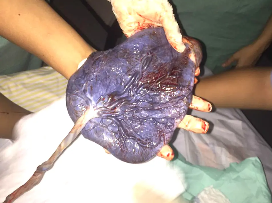 placenta, parto
