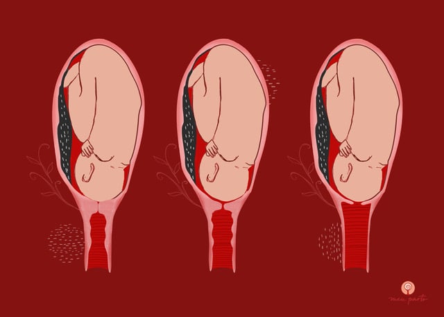 6 Dias De Atraso E Teste Negativo Colo Do Utero Fechado